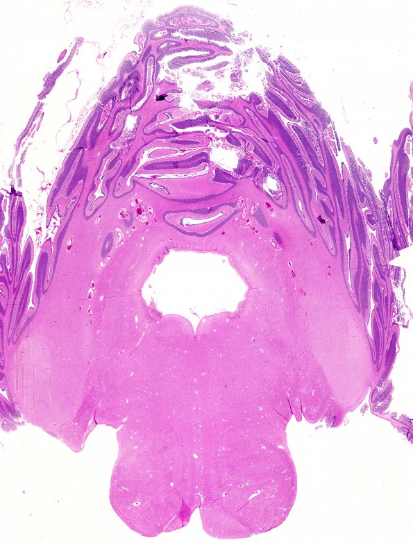 2A1 Ependymitis, granular, sp IVH (Case 2) H&E 1 whole mount