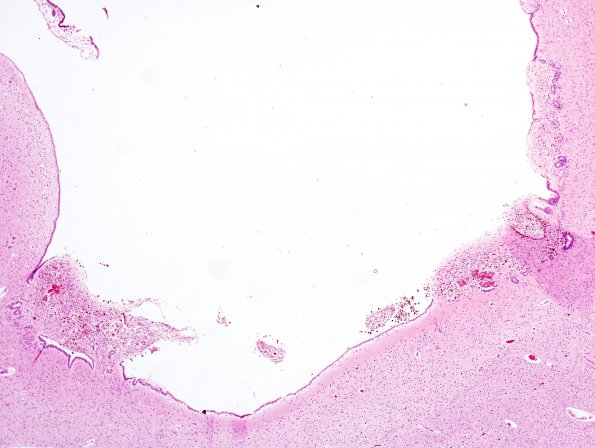 2A2 Ependymitis, granular, sp IVH (Case 2) H&E 2