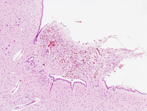 2A3 Ependymitis, granular, sp IVH (Case 2) H&E 3