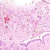 2A4 Ependymitis, granular, sp IVH (Case 2) H&E 4