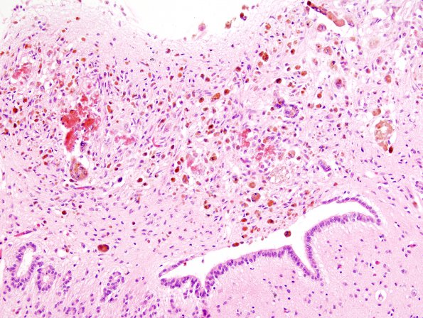 2A4 Ependymitis, granular, sp IVH (Case 2) H&E 4