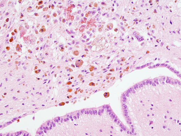 2A5 Ependymitis, granular, sp IVH (Case 2) H&E 5