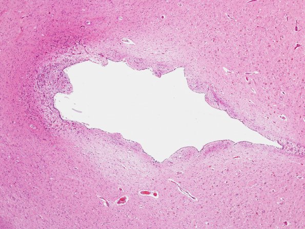 3A1 Rosenthal fibers, dorsal cerebral aqueduct (Case 3) H&E 1