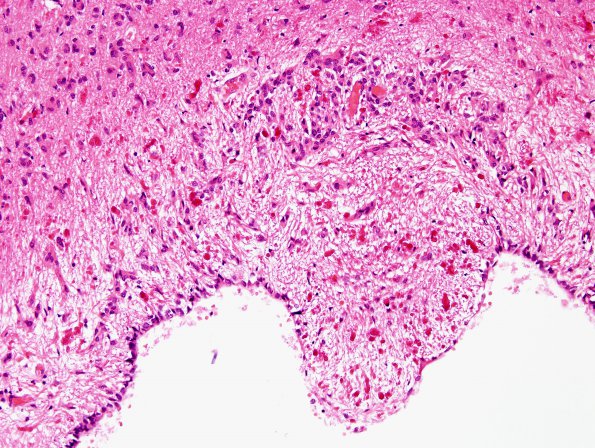 3A2 Rosenthal fibers, dorsal cerebral aqueduct (Case 3) H&E 2