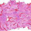 1A1 Non-necrotizing granulomatous inflammation (Case 2) periosteum-skull 1 H&E 1A