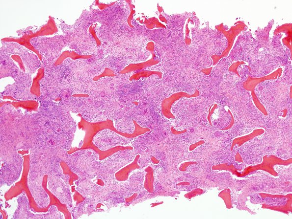 1A1 Non-necrotizing granulomatous inflammation (Case 2) periosteum-skull 1 H&E 1A