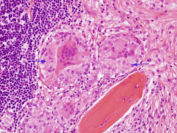 1A2 Non-necrotizing granulomatous inflammation (Case 2) periosteum-skull 1 H&E 1b