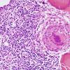 1A3 Non-necrotizing granulomatous inflammation (Case 2) periosteum-skull 1 H&E 3