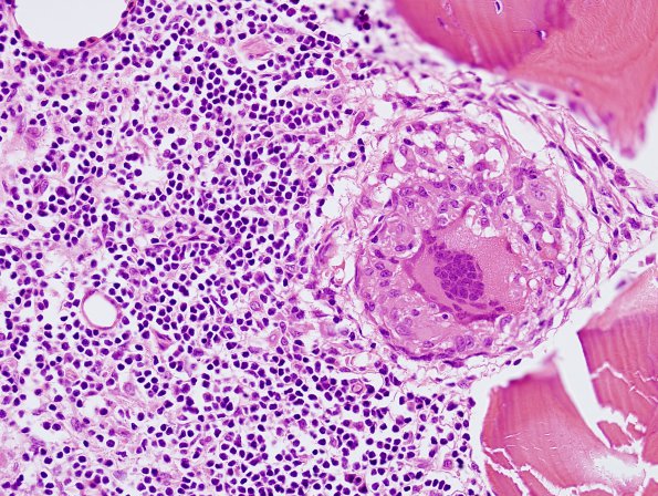 1A3 Non-necrotizing granulomatous inflammation (Case 2) periosteum-skull 1 H&E 3