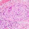 1A4 Non-necrotizing granulomatous inflammation (Case 2) periosteum-skull 1 H&E 11A