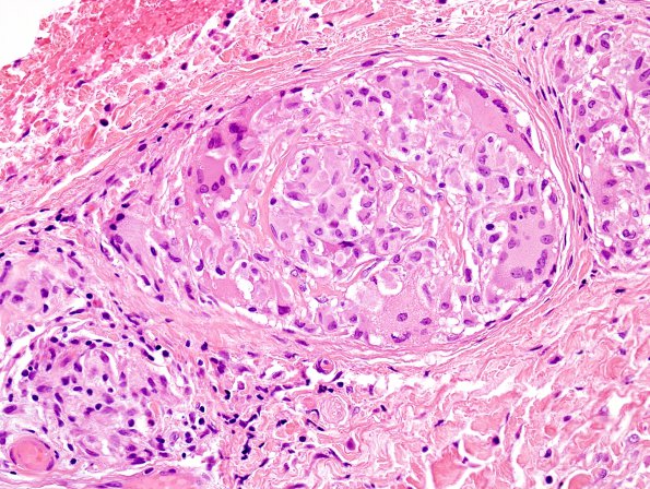 1A4 Non-necrotizing granulomatous inflammation (Case 2) periosteum-skull 1 H&E 11A