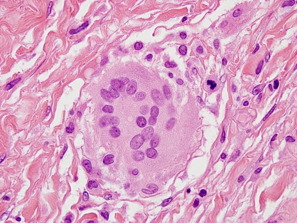 1A5 Non-necrotizing granulomatous inflammation (Case 2) periosteum-skull 1 H&E cleaved nuclei 3