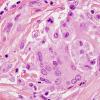 1A6 Non-necrotizing granulomatous inflammation (Case 2) periosteum-skull 1 H&E cleaved nuclei 4