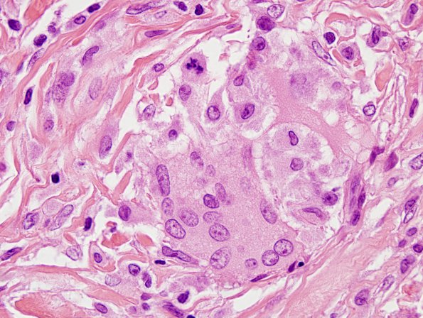 1A6 Non-necrotizing granulomatous inflammation (Case 2) periosteum-skull 1 H&E cleaved nuclei 4