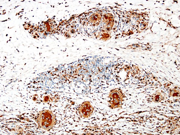 1A8 Non-necrotizing granulomatous inflammation (Case 2) periosteum-skull CD68 1A