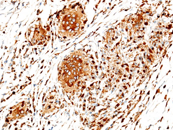 1A9 Non-necrotizing granulomatous inflammation (Case 2) periosteum-skull CD68 2A