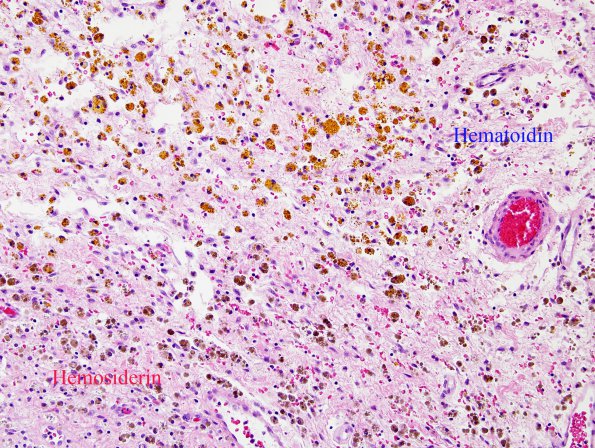 1A1 Hemosiderin & Hematoidin (Case 3) H&E 1