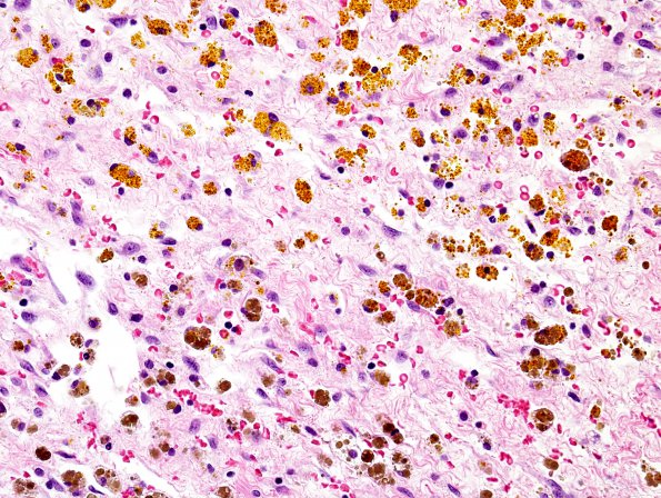 1A2 Hemosiderin & Hematoidin (Case 3) H&E 2