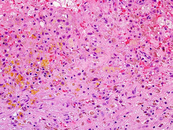 2A1 Hemosiderin & hematoidin (Case 4) H&E 1