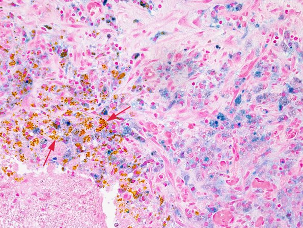 2A2 Hemosiderin & hematoidin (Case 4) Iron 1.