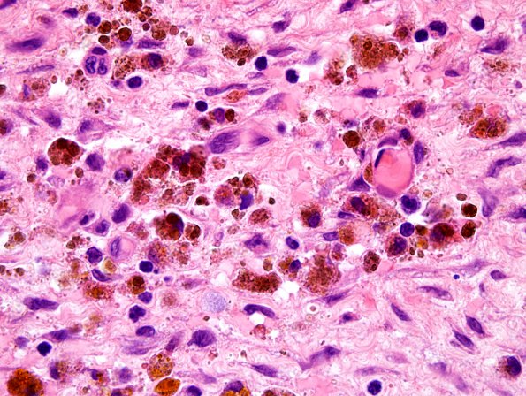 2A3 Hemosiderin, oil (Case 4) H&E 1