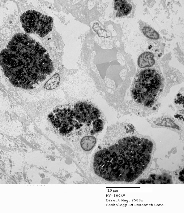 3A1 Hemosiderin, Cavernous hemangioma (Case 1) EM 079 - Copy