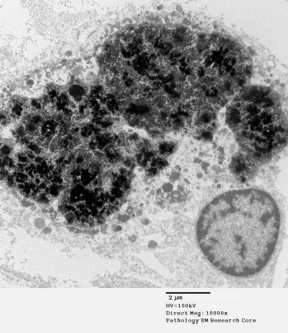 3A2 Hemosiderin, Cavernous hemangioma (Case 1) EM 081 - Copy