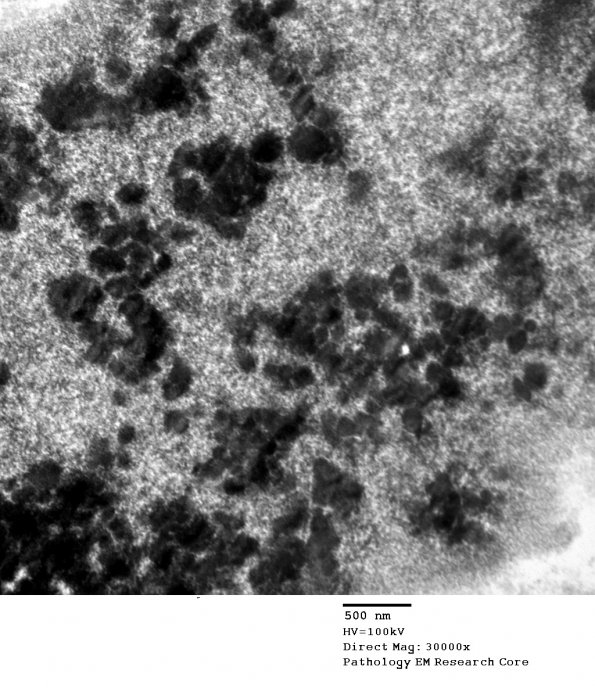 3A3 Hemosiderin, Cavernous hemangioma (Case 1) EM 083 - Copy