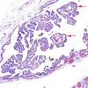 4A1 Hemosiderin, Choroid Plexus (Case 2) H&E 2