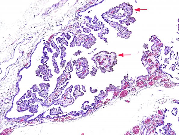 4A1 Hemosiderin, Choroid Plexus (Case 2) H&E 2