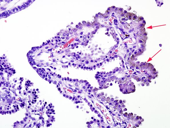 4A2 Hemosiderin, Choroid Plexus (Case 2) H&E 3