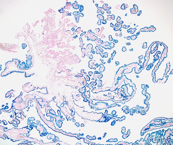 4A3 Hemosiderin, Choroid Plexus (Case 2) Prussian Blue 1A