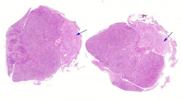 1A1 Herring bodies, neurohypophysis (Case 5) H&E 1