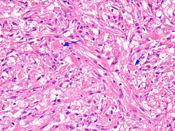 1A2 Herring bodies, neurohypophysis (Case 5) H&E 2