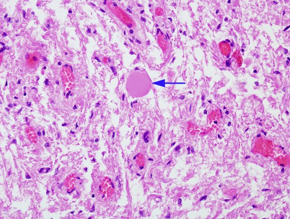 2 Herring bodies, neurohypophysis (Case 2) H&E 1