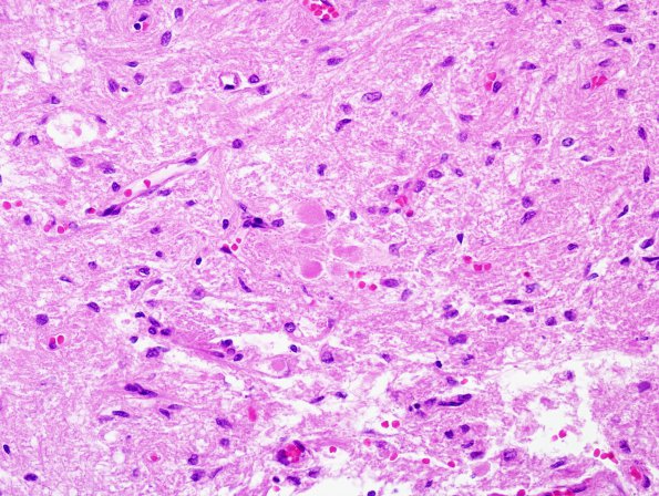 3 Herring bodies, neurohypophysis (Case 3) H&E 3