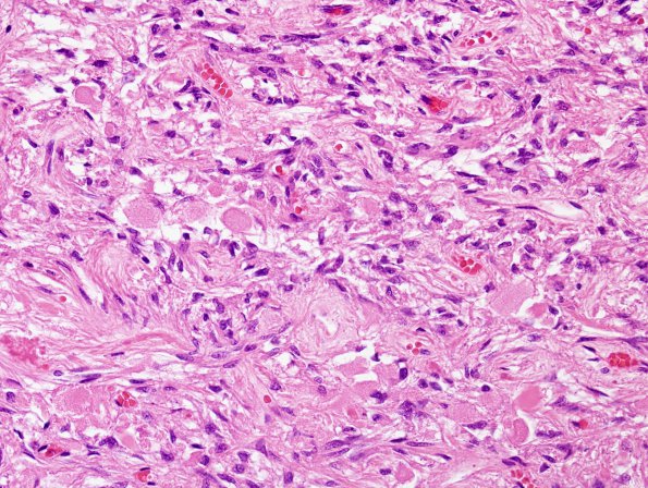 4A1 Herring bodies, neurohypophysis (Case 6) H&E 2