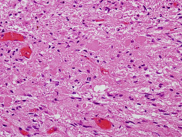 8A2 Pituitary, normal Hering bodies (Case 8) H&E 4