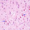 1A1 Hypoxia-Ischemia ENN (Case 3) H&E 1A