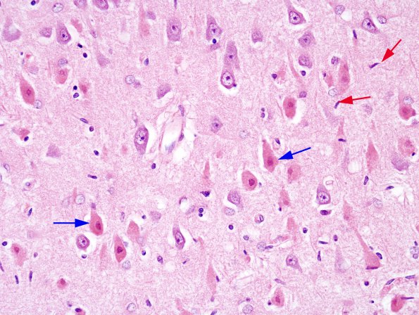 1A1 Hypoxia-Ischemia ENN (Case 3) H&E 1A