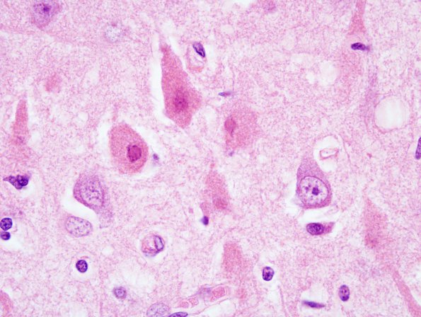 1A2 Hypoxia-Ischemia ENN (Case 3) H&E 2