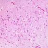 2A1 Hypoxia-Ischemia ENN (Case 4) H&E 1AA