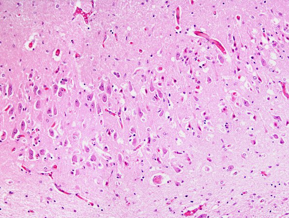 2A1 Hypoxia-Ischemia ENN (Case 4) H&E 1AA