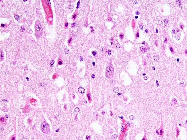 2A2 Hypoxia-Ischemia ENN (Case 4) H&E 3