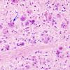 3A1 Hypoxia-Ischemia, eosinophilic neuronal necrosis, ENN (Case 6) H&E 1A