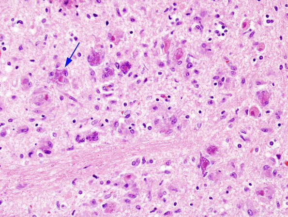 3A1 Hypoxia-Ischemia, eosinophilic neuronal necrosis, ENN (Case 6) H&E 1A