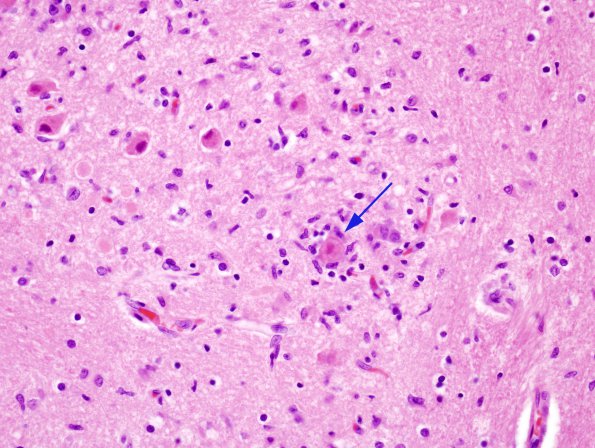 3A2 Hypoxia-Ischemia, eosinophilic neuronal necrosis, ENN (Case 6) H&E 2