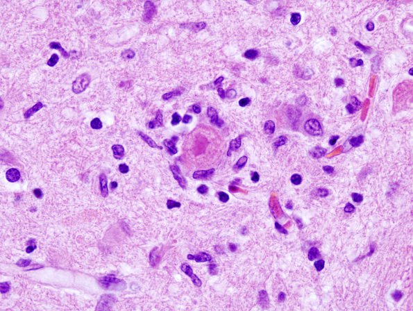 3A3 Hypoxia-Ischemia, eosinophilic neuronal necrosis, ENN (Case 6) neuronophagia, H&E 3