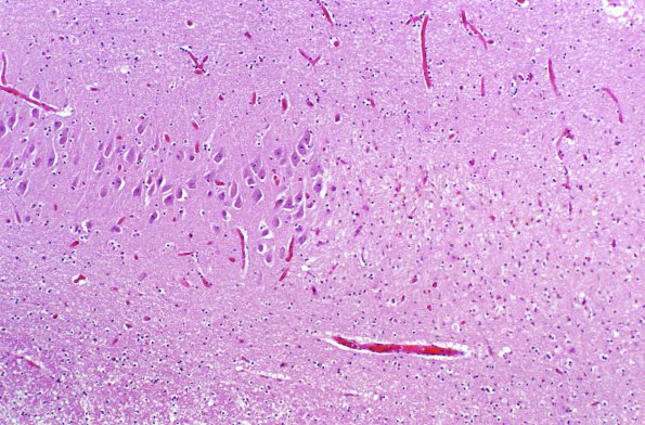 4A1 Hypoxia-Ischemia, hippocampus, remote H&E 1