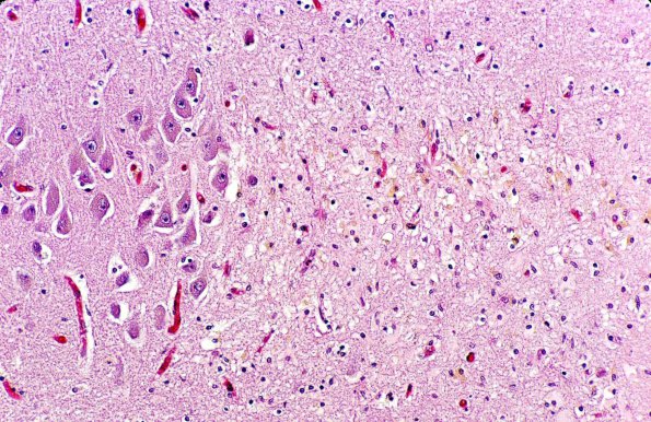 11 Hypoxia-Ischemia, hippocampus, remote H&E 2